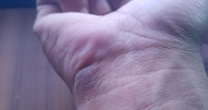 The Gamer’s Mark: Solving Hand Irritation from Extended Mouse Use